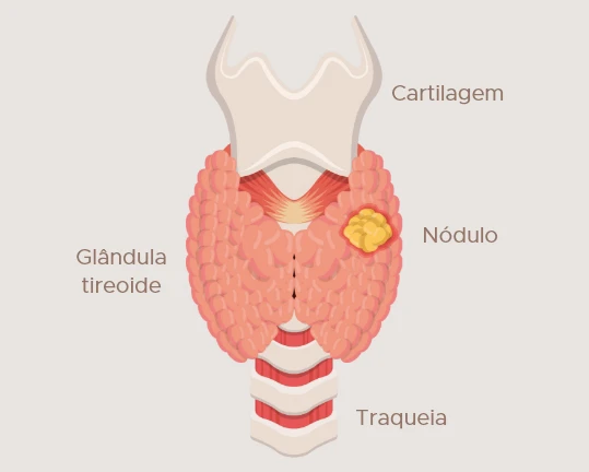 Doencas da Tireoide