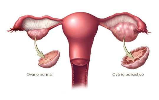 Sindrome do Ovario Policistico